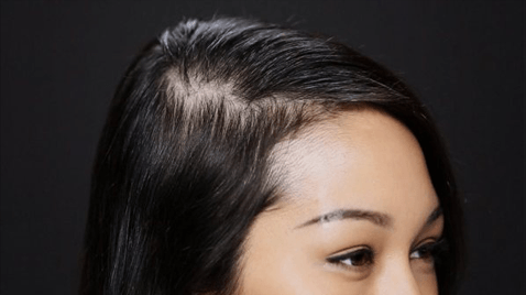 best treatment for regrowing hair